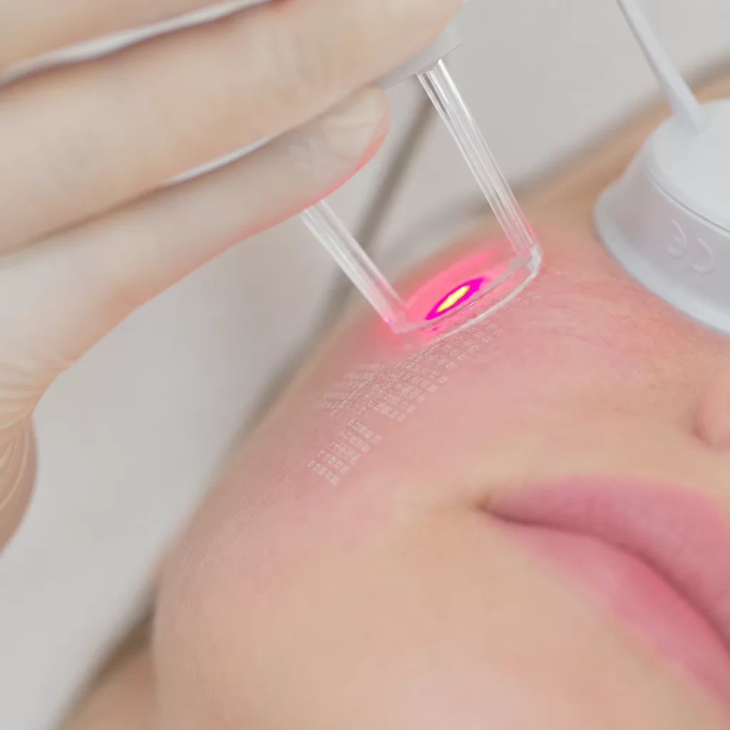 Fraktionierter Laser